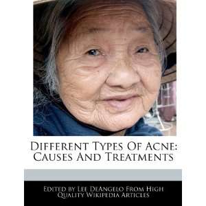 Different Types Of Acne Causes And Treatments Lee DeAngelo 